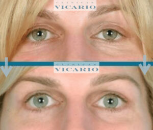 Tratamiento de la mirada con Lifting MuscularClinicas Vicario