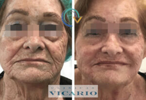 Antes y despues con enica de hilos tensores espiculados con bioestimulación del colágeno